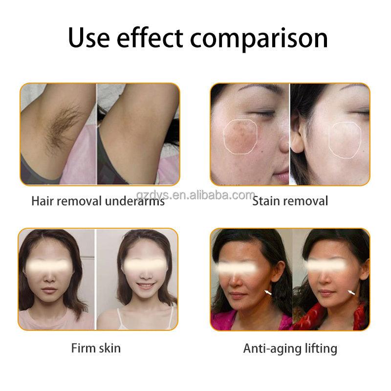 carbon laser hair removal 4 in 1 ipl laser hair remova RF Skin Rejuvenation elight opt ipl Hair tattoo Removal Machine - AOMIDY