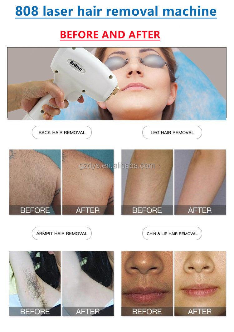 factory 808nm diode laser 500w 800w 1000w 1200w hair removal 808nm Diode Laser Hair Removal Machine Price - AOMIDY